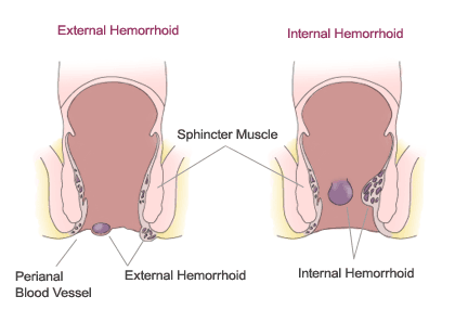 internal hemorrhoid bleeding