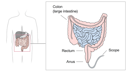 irritable bowel syndrome diagram